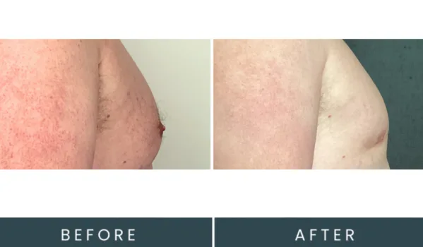 Before and after side view showing chest contour treatment results