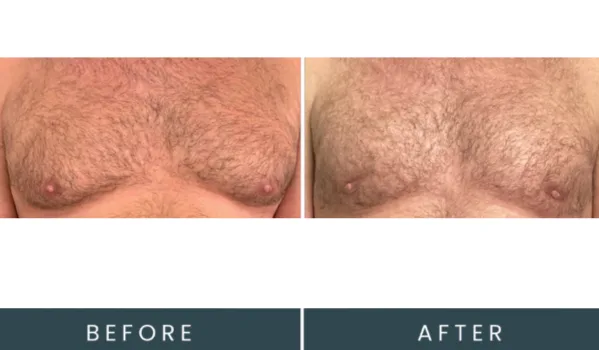 Before and after frontal view showing chest treatment with improved contour