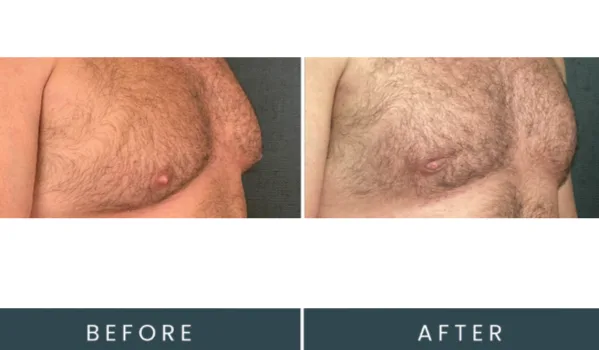 Before and after oblique view showing chest treatment with improved contour