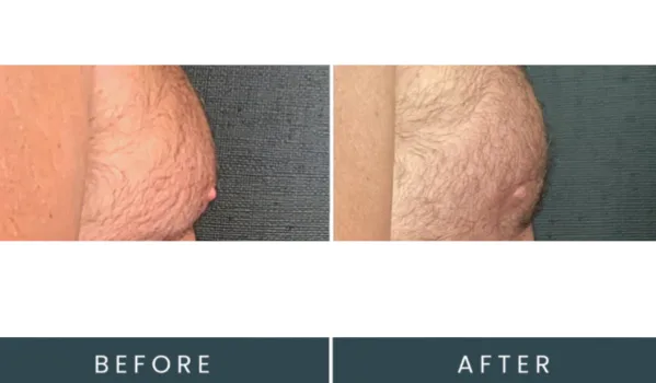 Before and after side view showing chest treatment with improved contour