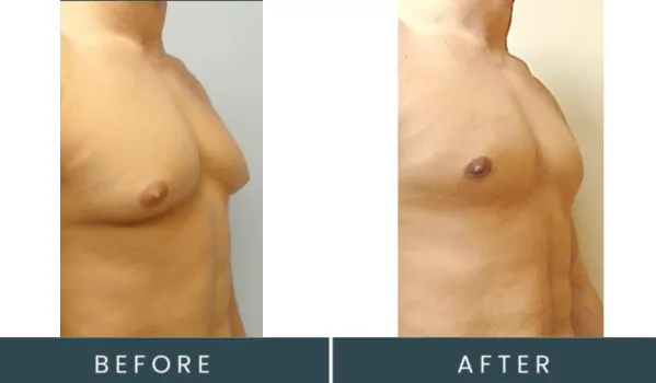Before and after side view comparison of male chest contouring treatment results