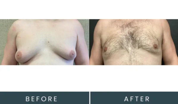 Before and after frontal view comparison of male chest contouring treatment results