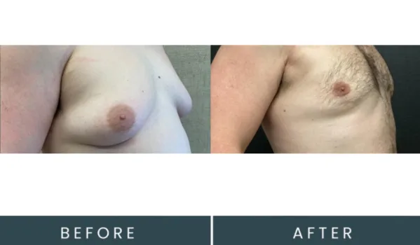 Before and after angled view comparison of male chest contouring treatment results