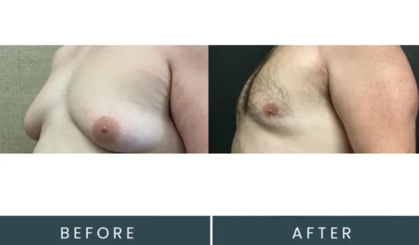 Before and after gynecomastia treatment showing chest contour improvement