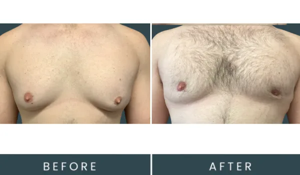 Before and after gynecomastia surgery, front view showing smaller, more contoured pectoral area