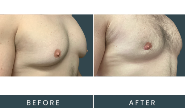 Gynecomastia 29 2