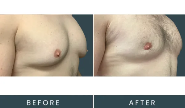 Before and after gynecomastia surgery, oblique view showing flattened chest and normalized nipple position