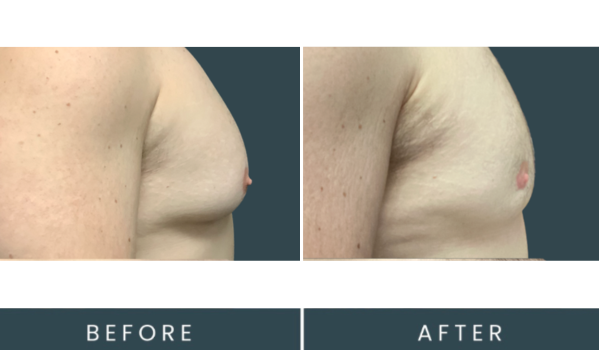 Gynecomastia 29 3