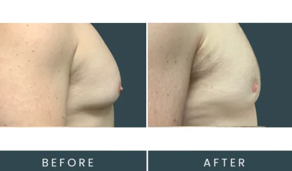 Before and after gynecomastia surgery, side view showing reduced breast tissue and improved chest contour