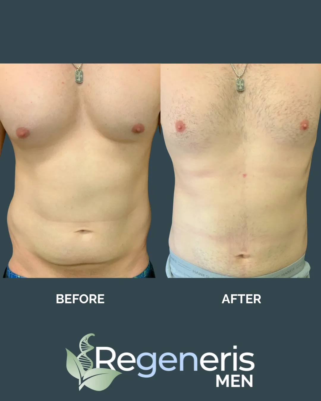 Male liposuction before and after comparison, front view showing chest and abdominal definition