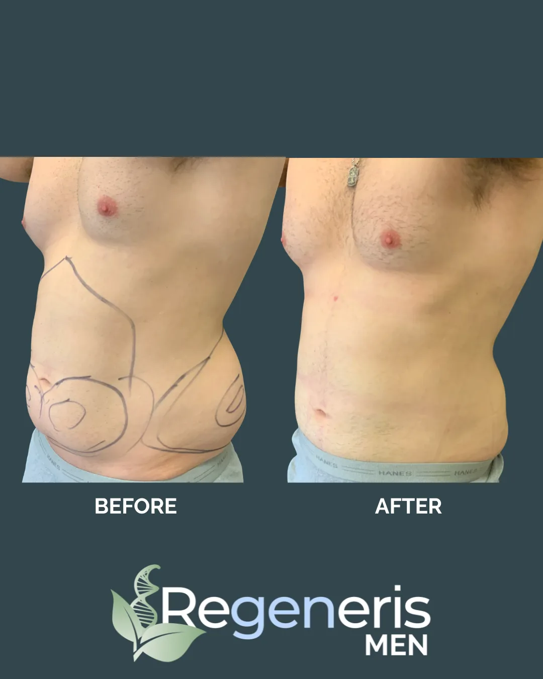 Male liposuction before and after comparison, oblique view with surgical markings showing flank and abdominal contouring