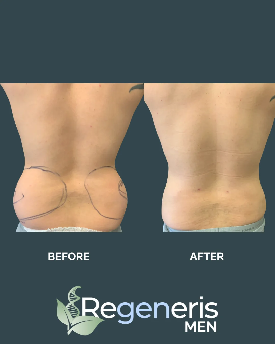 Male liposuction before and after comparison, rear view with surgical markings showing lower back and hip definition