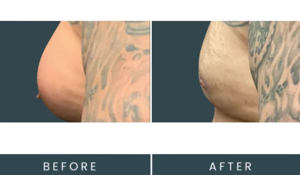Before and after chest contouring on tattooed male patient in side profile, labeled before and after