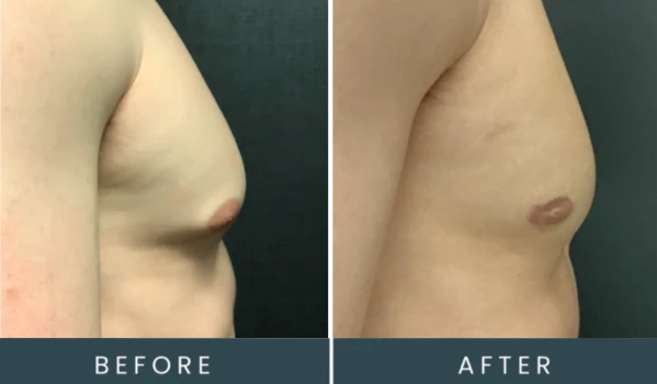 Before and after male chest treatment side profile, labeled before and after