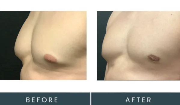 Before and after male chest enhancement front view, labeled before and after