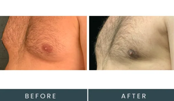 Before and after male chest contouring side profile, labeled before and after