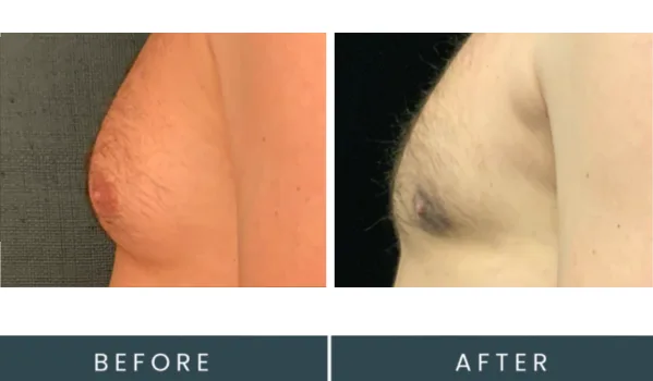 Before and after side profile comparison of male chest enlargement results