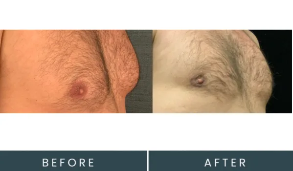 Before and after side profile comparison of male chest enlargement results