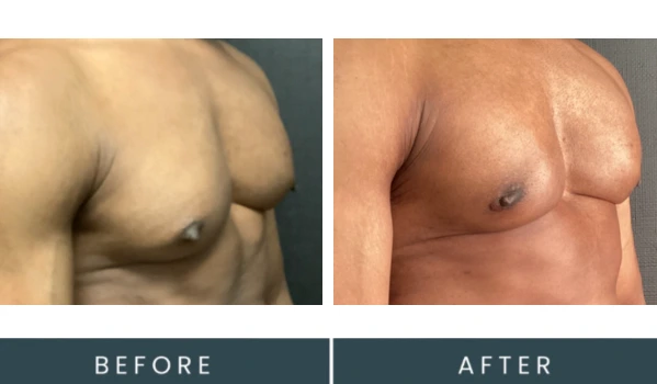 Before and after gynecomastia treatment showing reduced breast tissue and improved chest contour