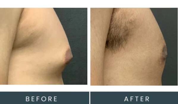 Gynecomastia case 34 before and after side-profile comparison showing chest contour reduction