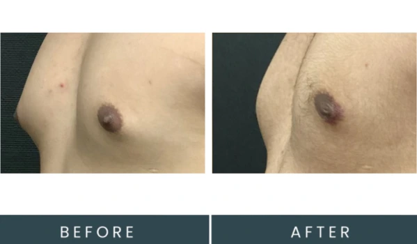 Gynecomastia case 34 before and after front-facing comparison showing breast tissue reduction