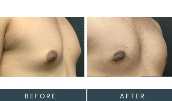 Gynecomastia case 34 before and after three-quarter view comparison showing chest definition improvement