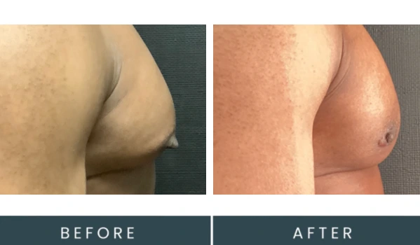 Before and after gynecomastia treatment showing reduced breast tissue and improved chest contour