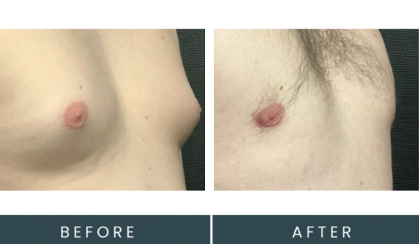 Gynecomastia case 35 before and after side-profile comparison showing chest contour reduction