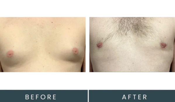 Gynecomastia case 35 before and after front-facing comparison showing bilateral breast tissue reduction