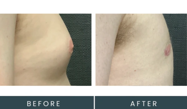 Gynecomastia case 35 before and after three-quarter view comparison showing chest definition improvement
