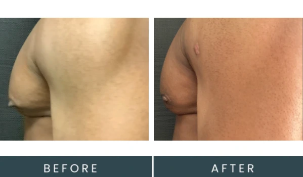 Before and after gynecomastia treatment showing reduced breast tissue and improved chest contour