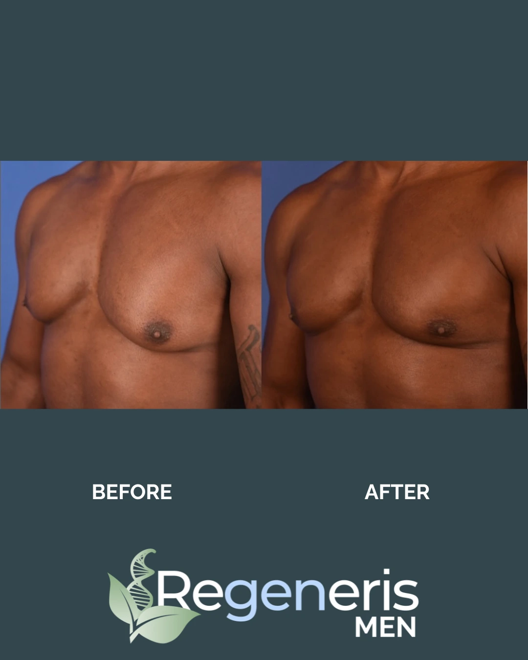 Before and after male torso showing reduced chest and abdominal contours with Regeneris Men logo