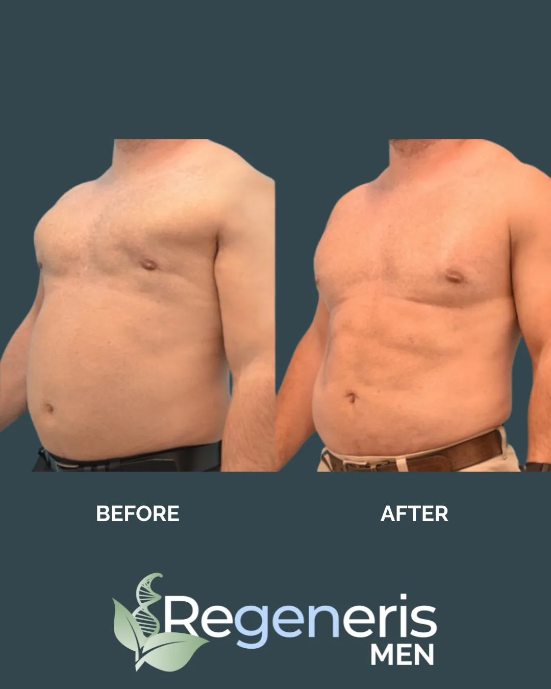 Before and after male torso showing reduced abdominal contours with Regeneris Men logo