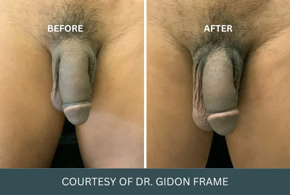 Before and after comparison of penis enlargement case 10 courtesy of Dr. Gidon Frame