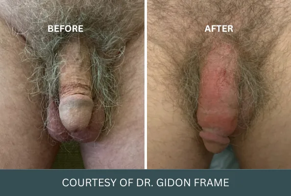 Before and after comparison of penis enlargement case 13 courtesy of Dr. Gidon Frame