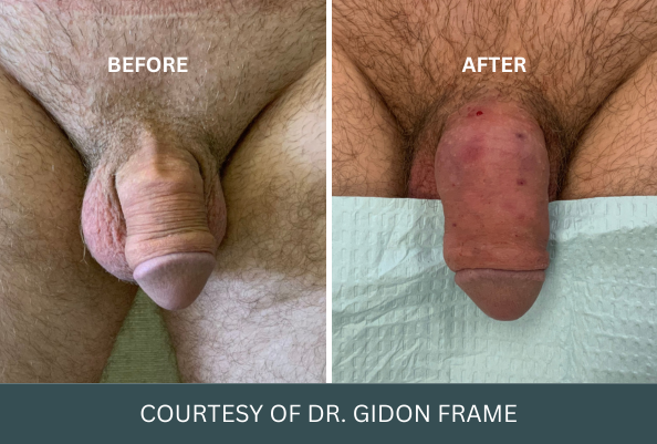 Before and after comparison of penis enlargement case 14 courtesy of Dr. Gidon Frame