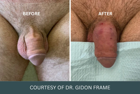 Before and after comparison of penis enlargement case 14 courtesy of Dr. Gidon Frame