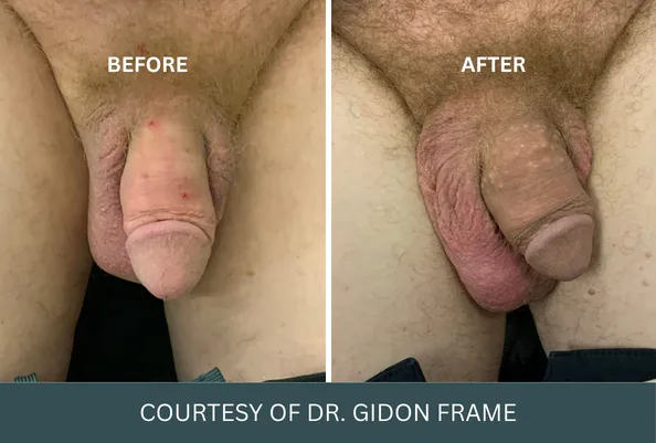 Before and after penis enlargement case 16 courtesy of Dr. Gidon Frame
