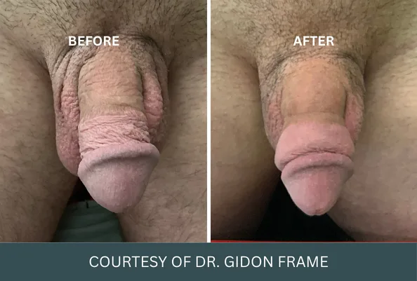 Before and after penis enlargement case 17 courtesy of Dr. Gidon Frame