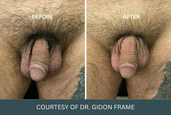Before and after penis enlargement case 18 courtesy of Dr. Gidon Frame