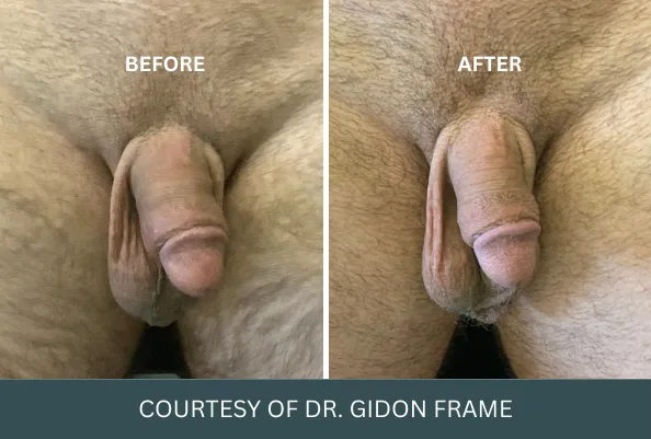Before and after penis enlargement case 19 courtesy of Dr. Gidon Frame