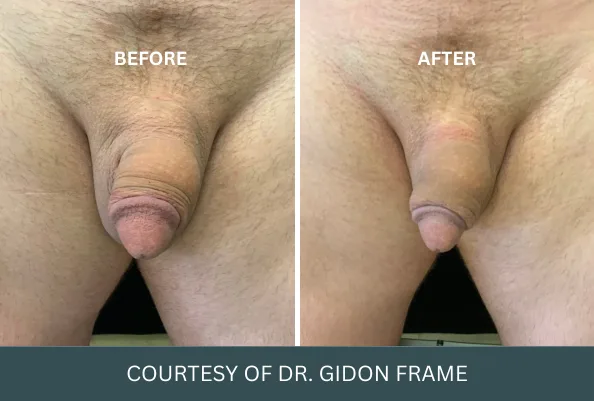 Before and after comparison of penis enlargement procedure by Dr. Gidon Frame