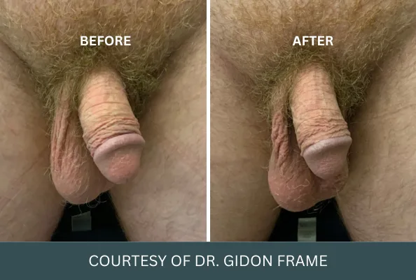 Before and after comparison of penis enlargement procedure by Dr. Gidon Frame