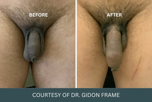 Before and after penis enlargement case 27, courtesy of Dr. Gidon Frame