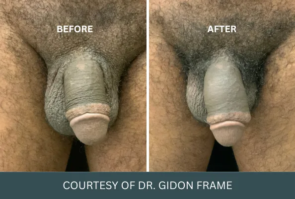 Before and after penis enlargement case 28, courtesy of Dr. Gidon Frame