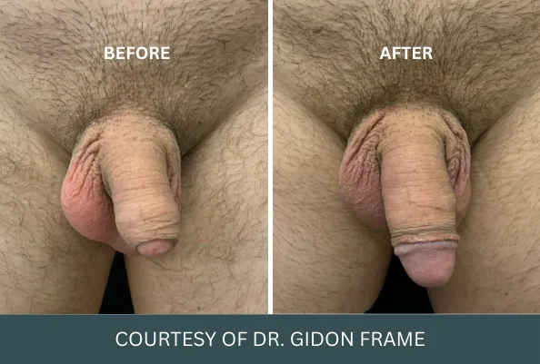 Before and after comparison showing penis enlargement results, courtesy of Dr. Gidon Frame