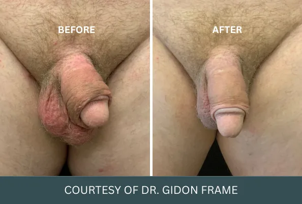 Before and after comparison showing penis enlargement results, courtesy of Dr. Gidon Frame