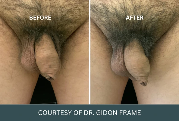 Before and after comparison of penis enlargement results, courtesy of Dr. Gidon Frame