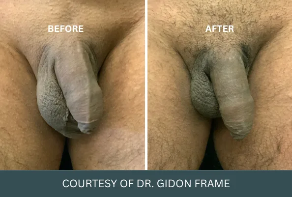 Before and after comparison of penis enlargement results, courtesy of Dr. Gidon Frame