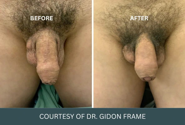 Before and after comparison of penis enlargement results, courtesy of Dr. Gidon Frame